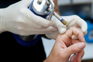 Кріодеструкція як метод видалення новоутворень: переваги та особливості процедури